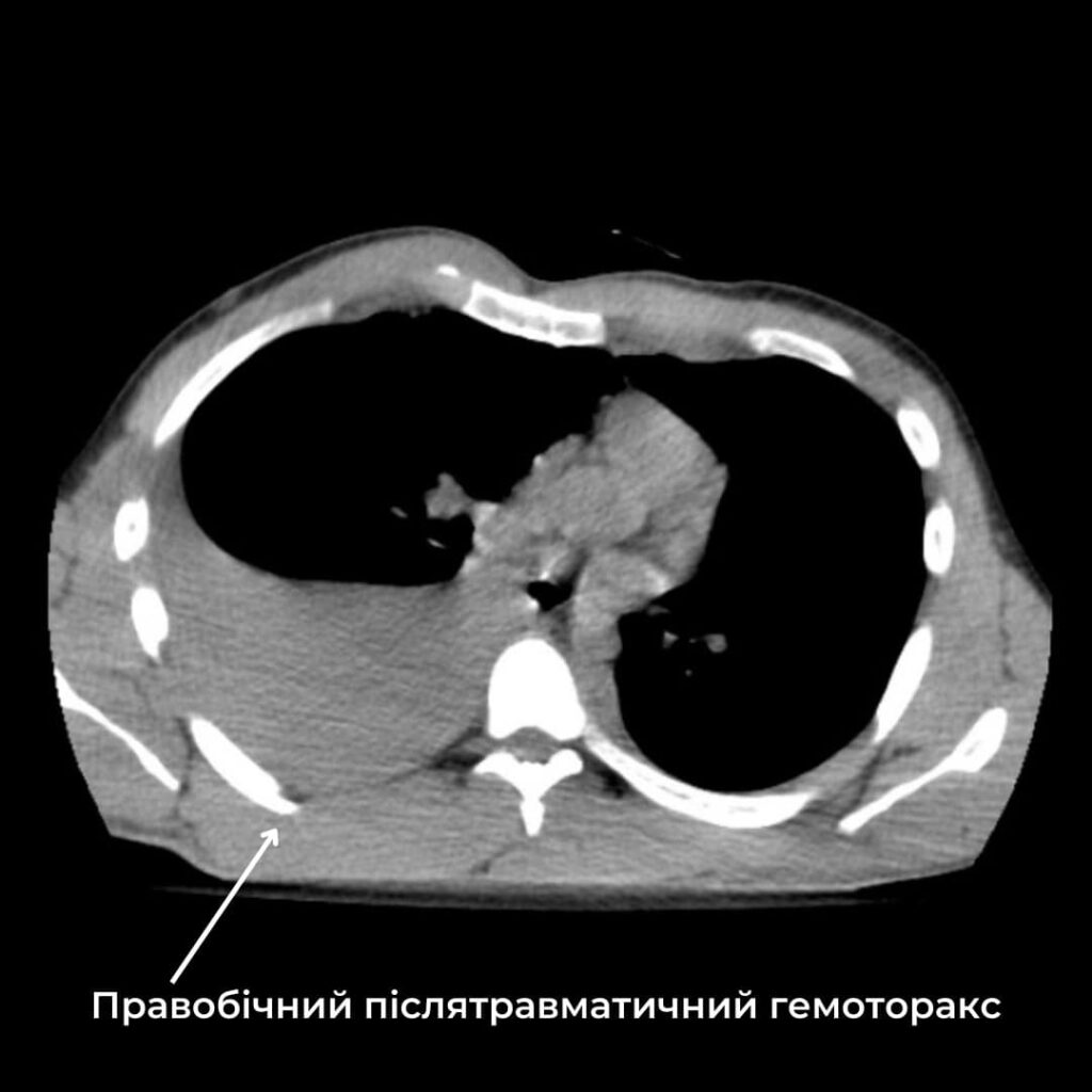 КТ-діагностика торакальної травми | МЦ "ЄВРОКЛІНІК"