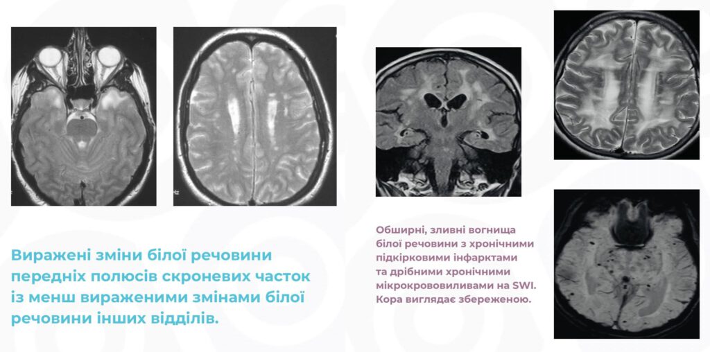 Важливість МРТ для діагностики CADASil  | МЦ "ЄВРОКЛІНІК"