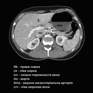 Інформативність КТ при діагностиці «синдрому Лускунчика» | "Євроклінік"