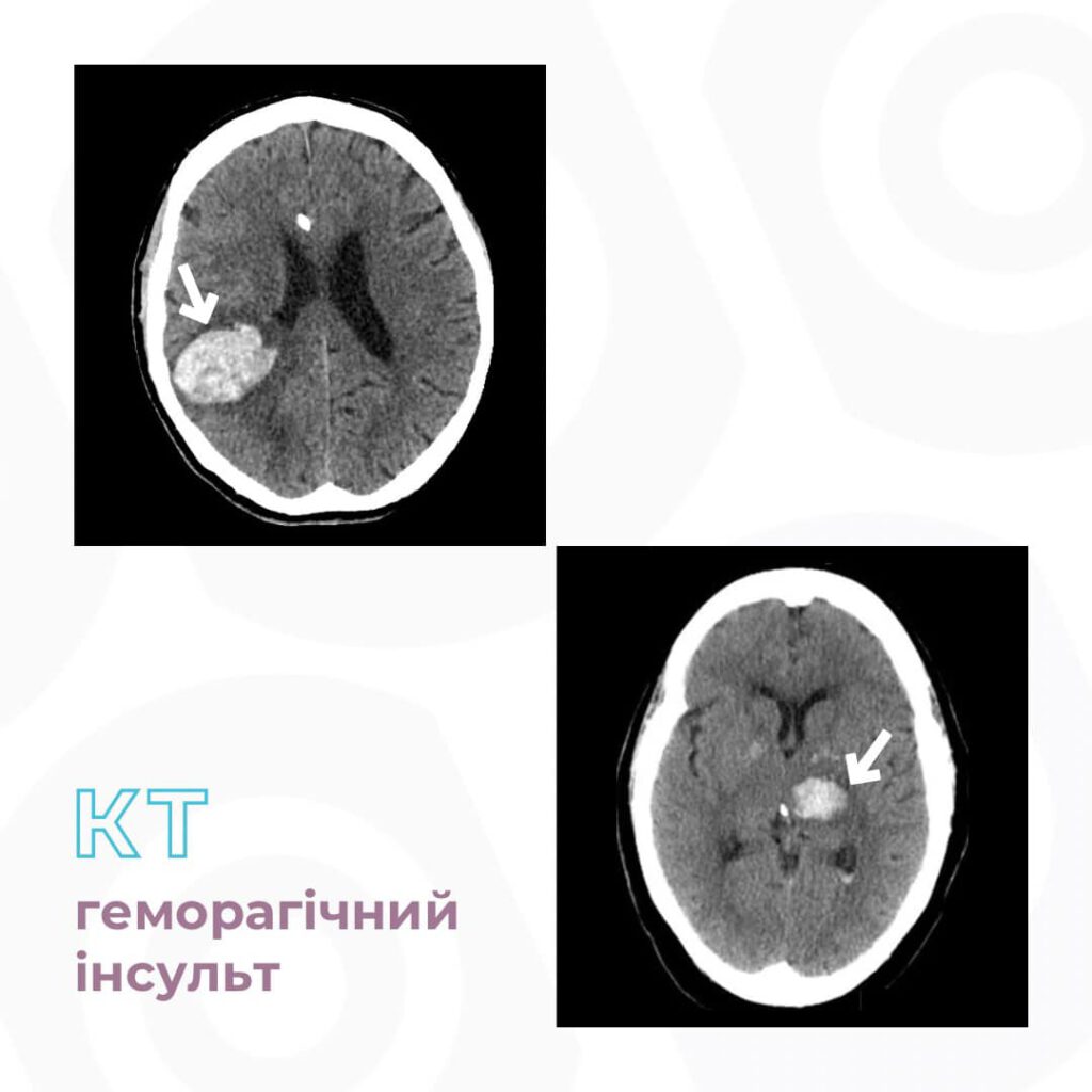 КТ голови при геморагічному інсульті | МЦ "Євроклінік"
