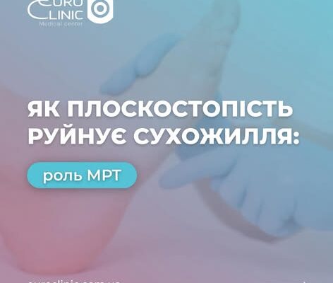 Плоскостопість може пошкоджувати сухожилля