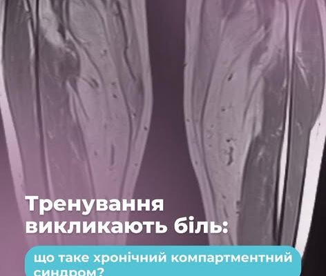 Займаєтеся спортом, а біль у ногах лише посилюється?
